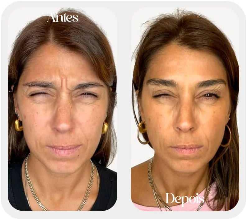 Se pensa em eliminar rugas precisa fazer o botox em sp