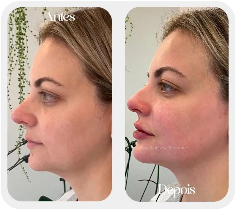 Preenchimento de queixo em SP