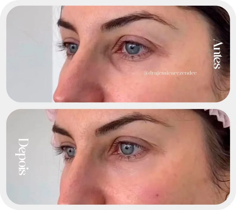 Diminuindo as olheiras com preenchimento na região dos olhos