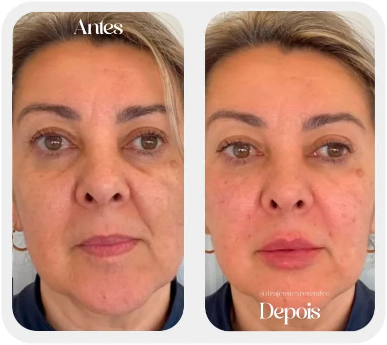 Preenchimento Labial em Alphaville SP