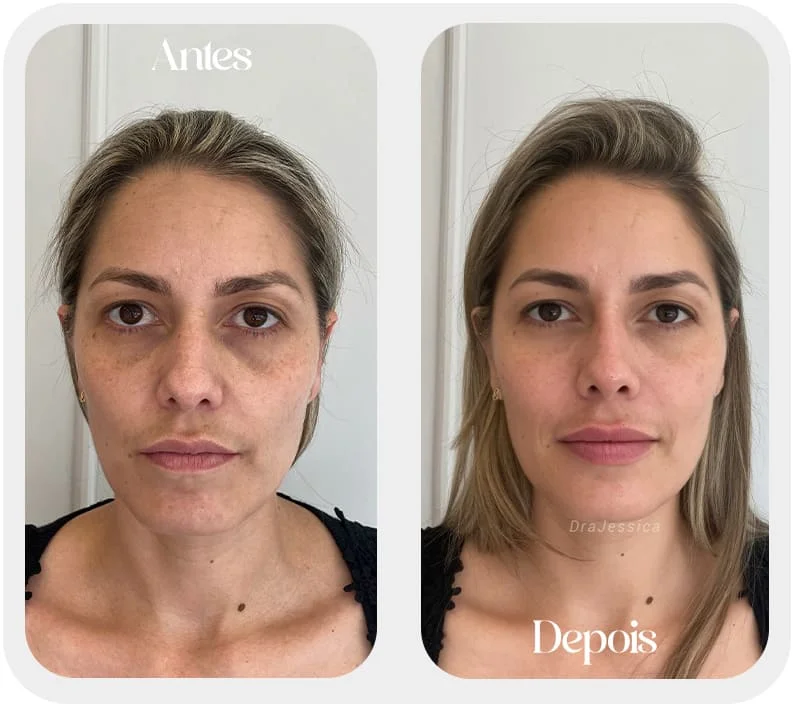 Preenchimento Labial em SP