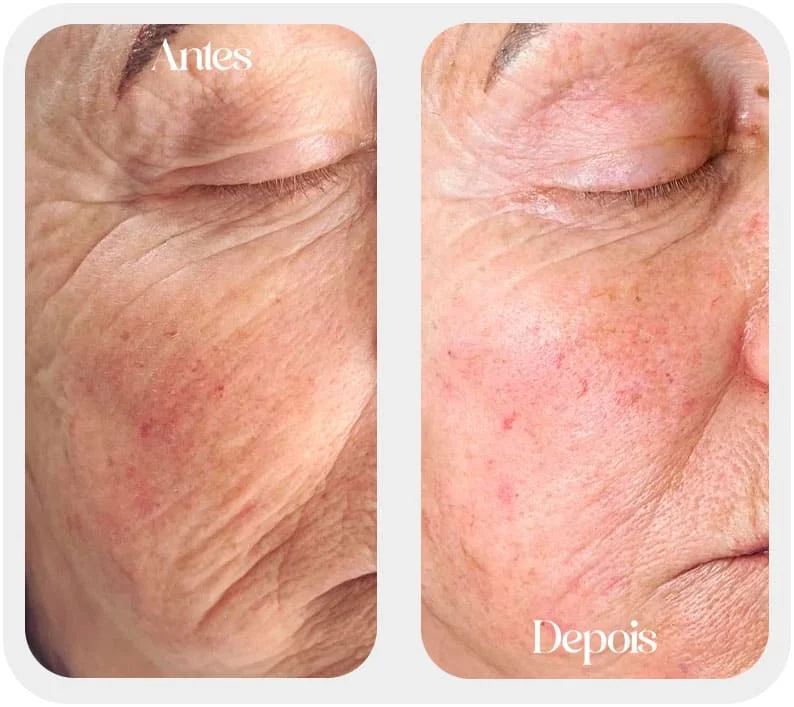 Aplicação de Botox em SP. Antes e depois da aplicação